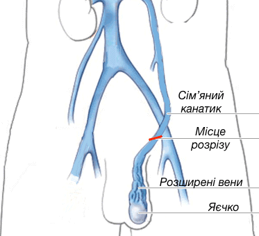 варикоцелеектомія